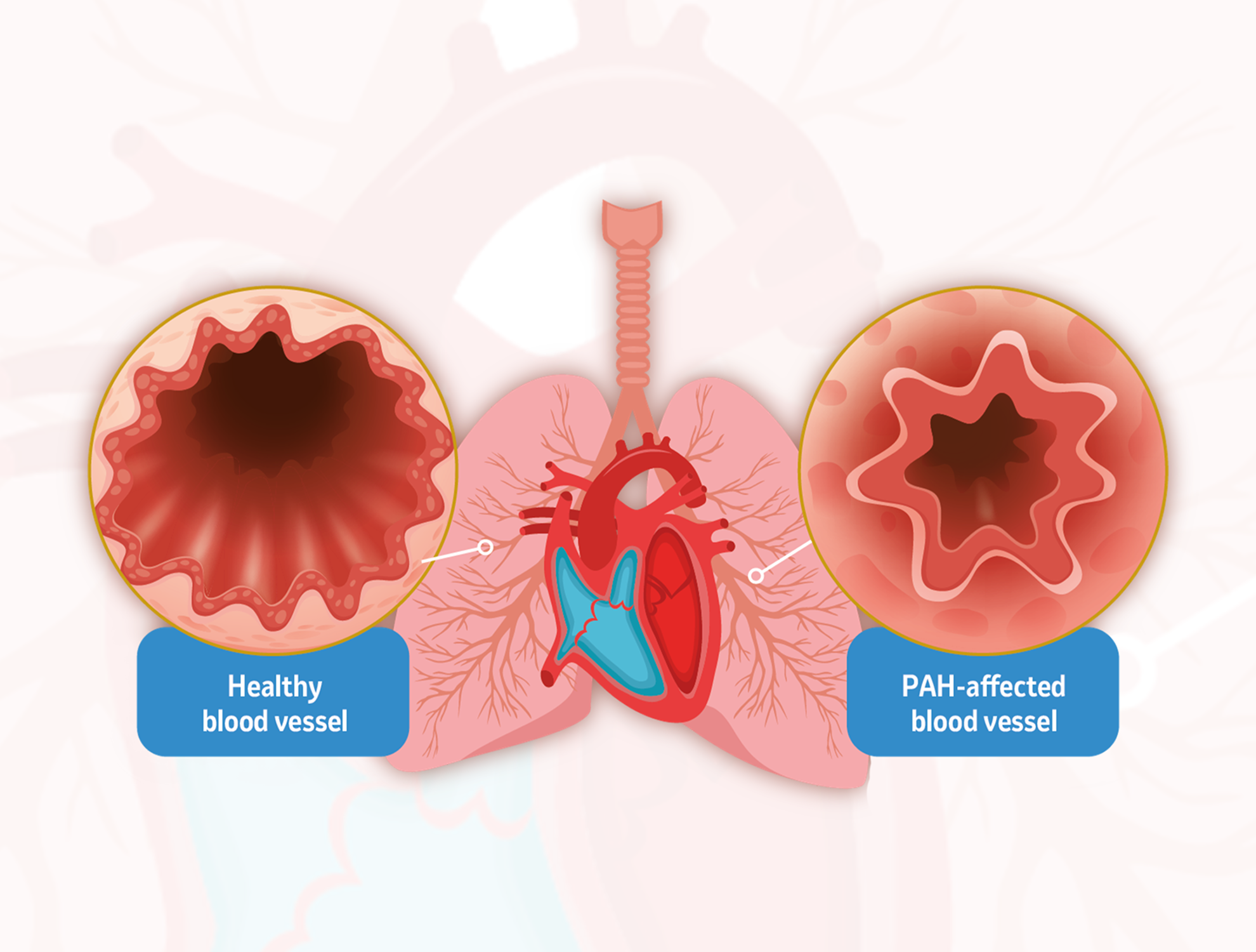 diagram showing a human heart and lungs. The diagram also shows a through section of a healthy blood vessel, and a through section of a PAH-affected blood vessel